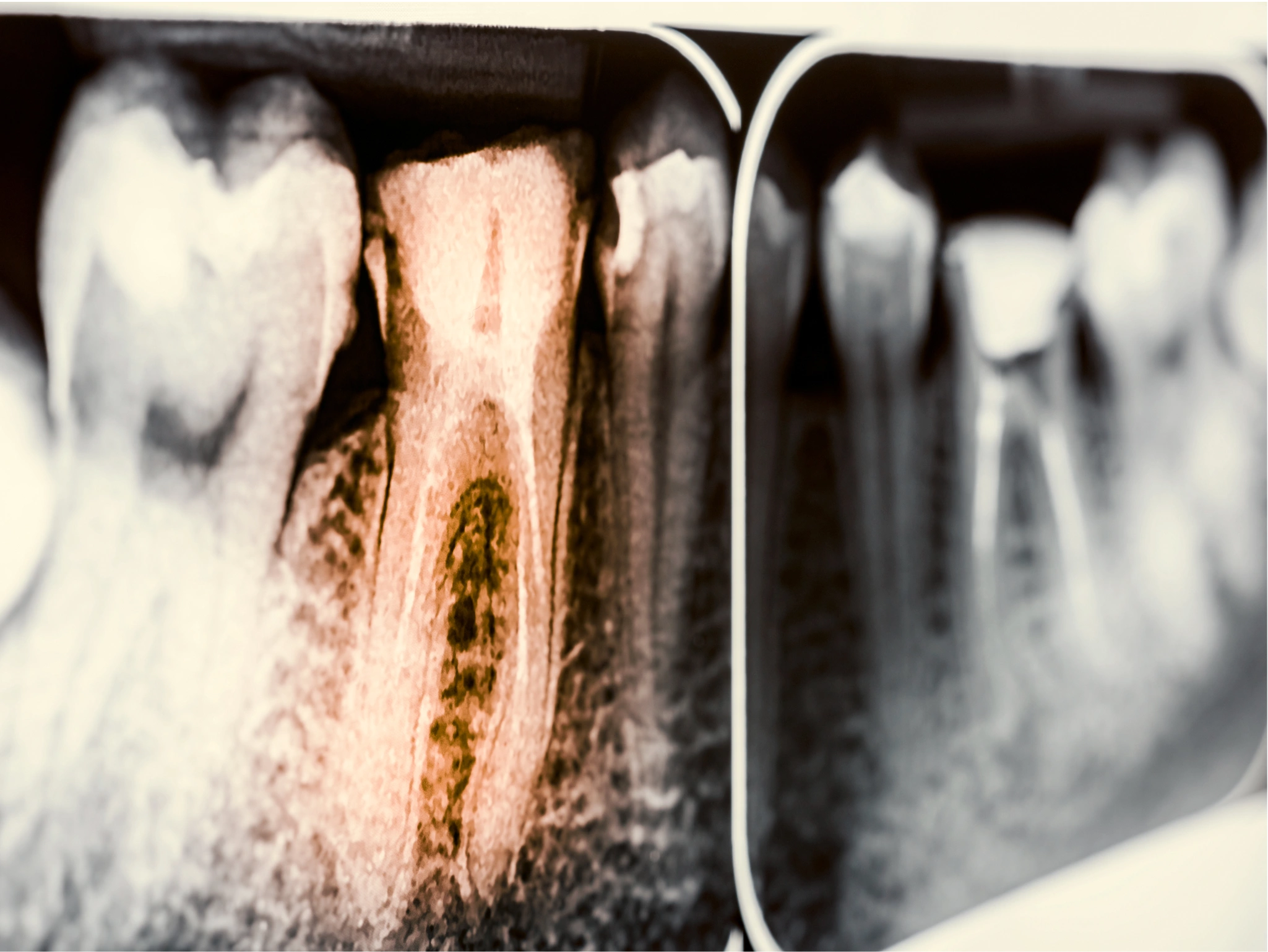 Endodoncia