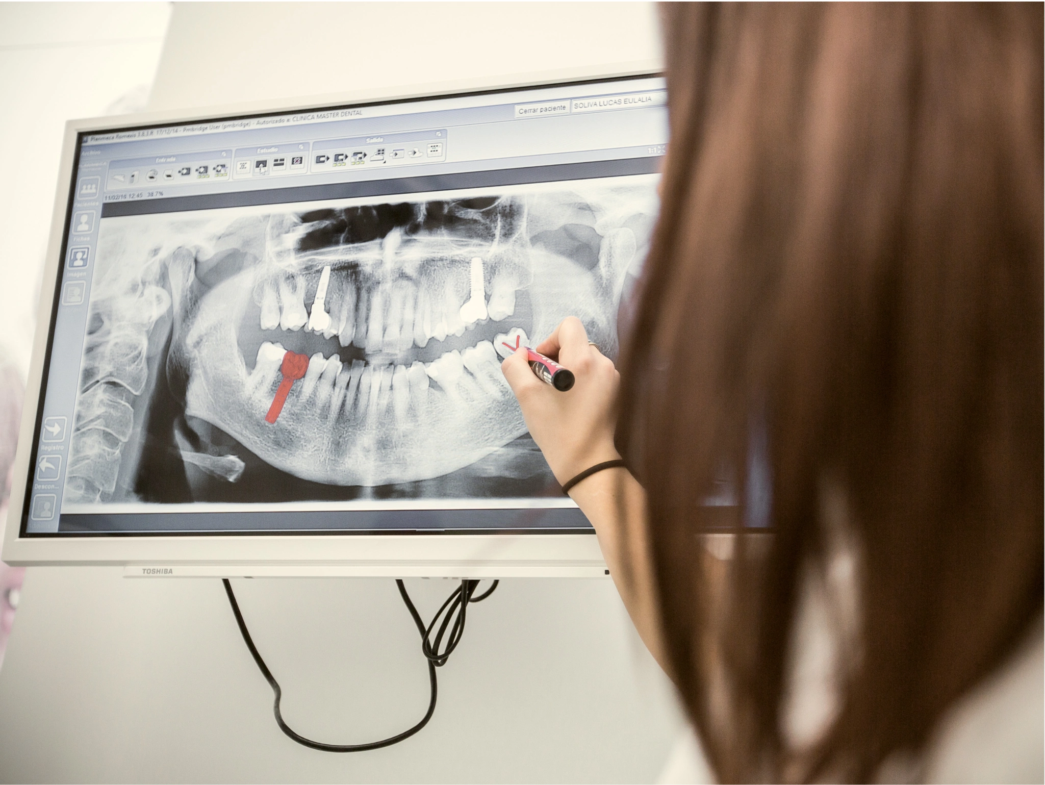 Implants dentals