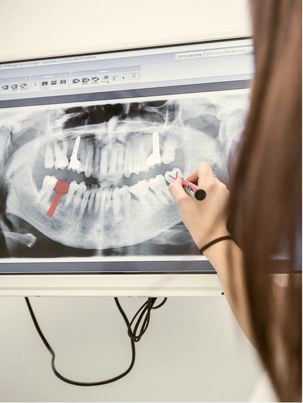 Implants dentals